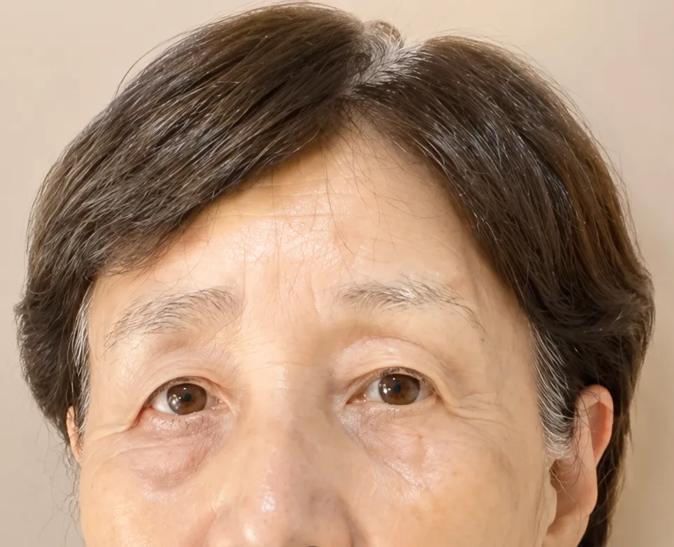 眉施術前（事例3）